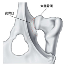 股関節形成不全